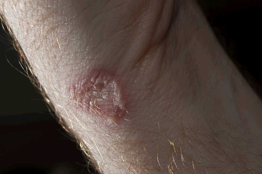 ringworm-fungal-infection-causes-symptoms-and-treatment-treating-fungus